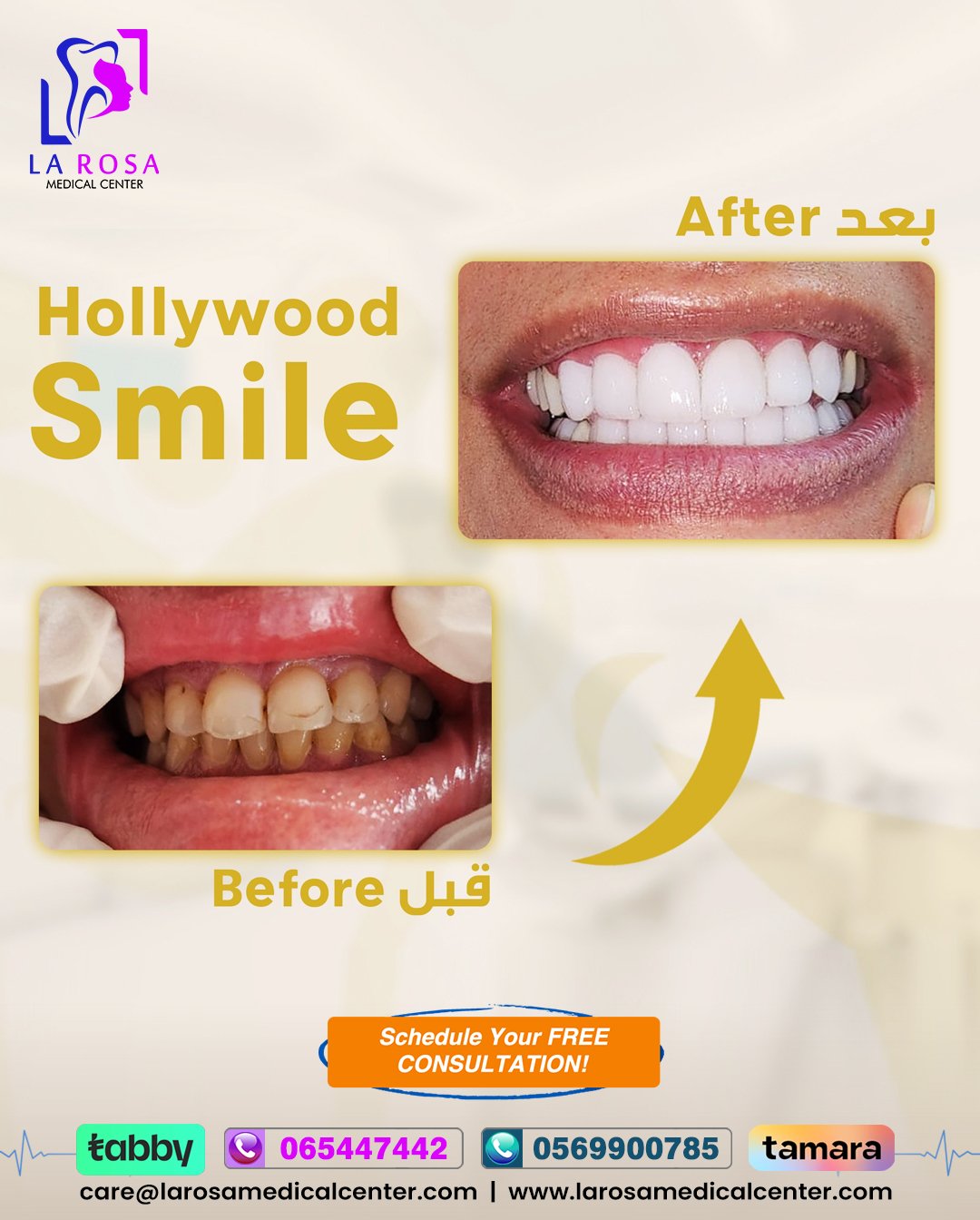 Hollywood Smile